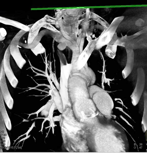 Right Subclavian Artery Aneurysm Vascular Case Studies Ctisus Ct