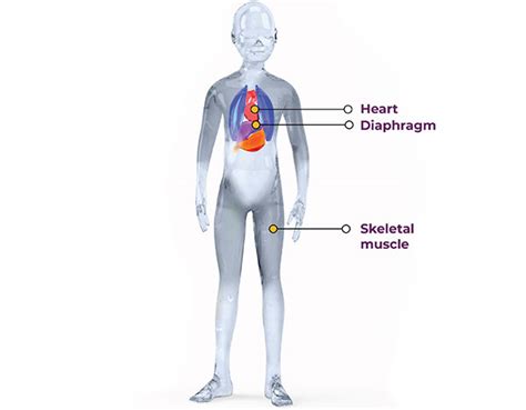 Duchenne Muscular Dystrophy Diagram