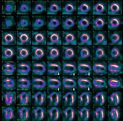 Specific Manifestation Of Single Photon Emission Computed Tomography