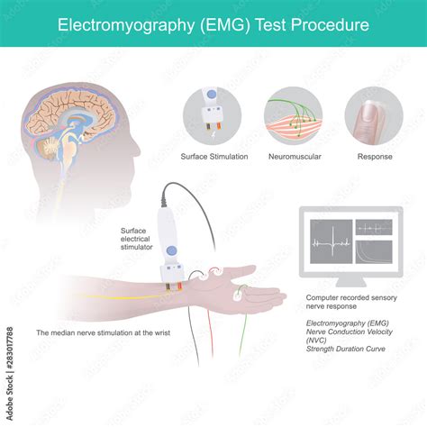 Electromyography Test Procedure. Stock Vector | Adobe Stock