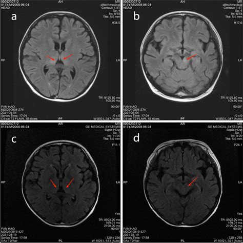 Ad Brain Mri Revealed Abnormal Signal Foci In The Left Midbrain