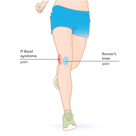 Iliotibial Band Syndrome Knee Pain Iliotibial Tract H