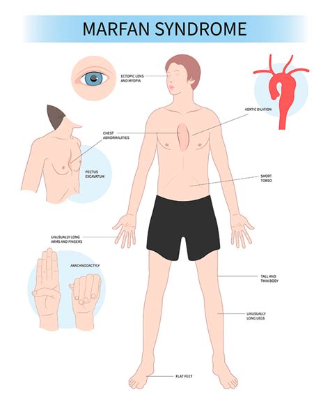 Síndrome De Marfan Cardiopatías Congénitas La Paz