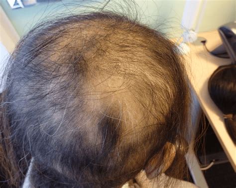 Telogen Effluvium Beforeafter Treatment Photos The Hair Loss Centre