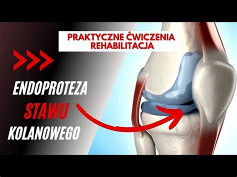 Endoproteza stawu kolanowego SKUTECZNE ĆWICZENIA REHABILITACJA