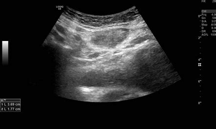 Cesarian scar endometriosis | Radiology Case | Radiopaedia.org