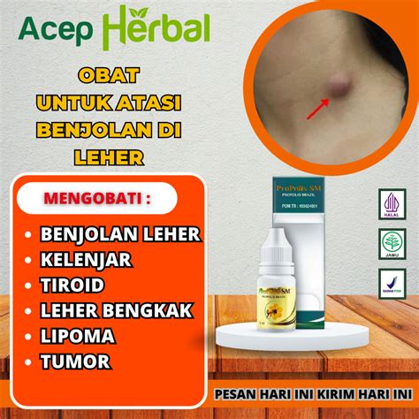 Jual Obat Oles Benjolan Di Leher Hipertiroid Kelenjar Getah Bening