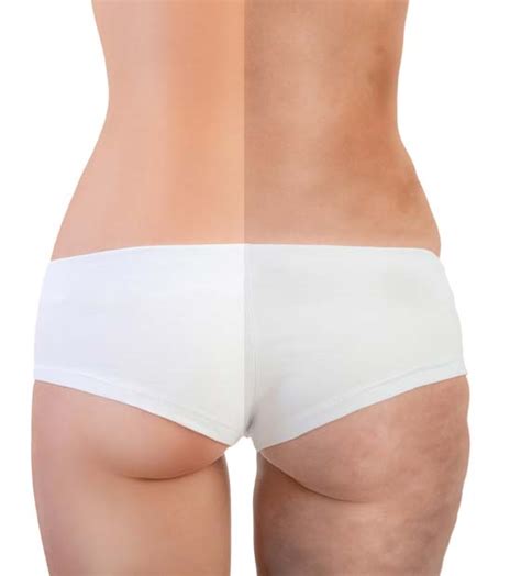 Bodyfx And Minifx Cellulite Reduction Elkhart In Elite Aesthetics