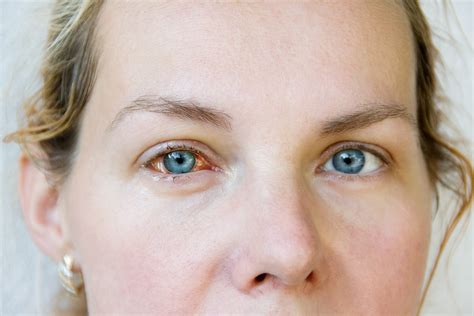 Watery Eyes – Oculofacial Plastic and Orbital Surgery