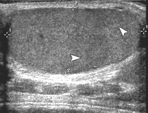 Sonographic Diagnosis Of A Ruptured Intratesticular Pseudoaneurysm