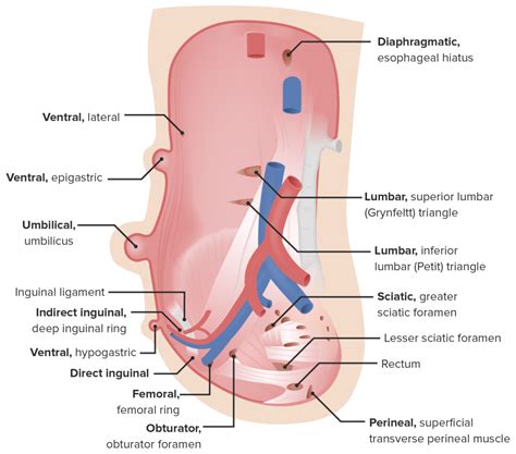 Hérnias Abdominais Tipos e Tratamento Cirúrgico Concise Medical