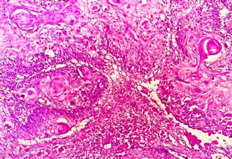 Squamous Cell Carcinoma Of The Urinary Bladder Clinicopathological And Molecular Update