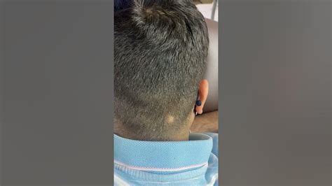 Alopecia Areata Treatment With Intralesional Injection Youtube