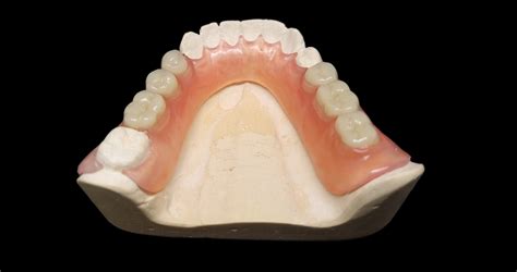 Valplast - Alize Dentaire
