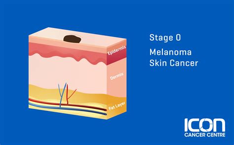 Skin Cancer Stages