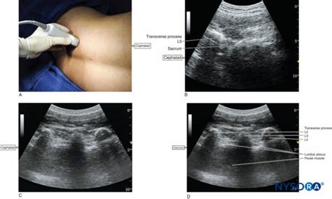 Sonography Of The Lumbar Paravertebral Space And Considerations For The