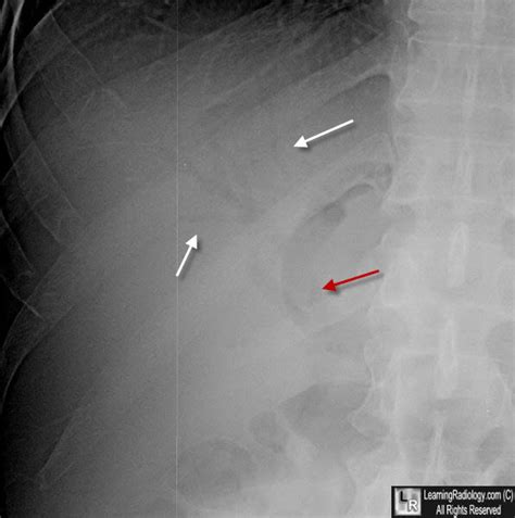 Learning Radiology Air In The Biliary System Pneumobilia