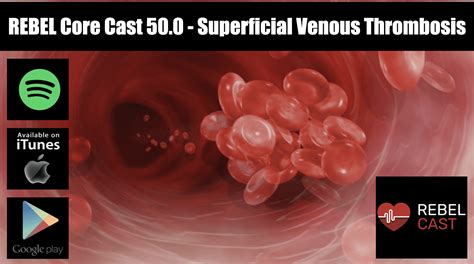 Rebel Core Cast Superficial Venous Thrombosis Rebel Em