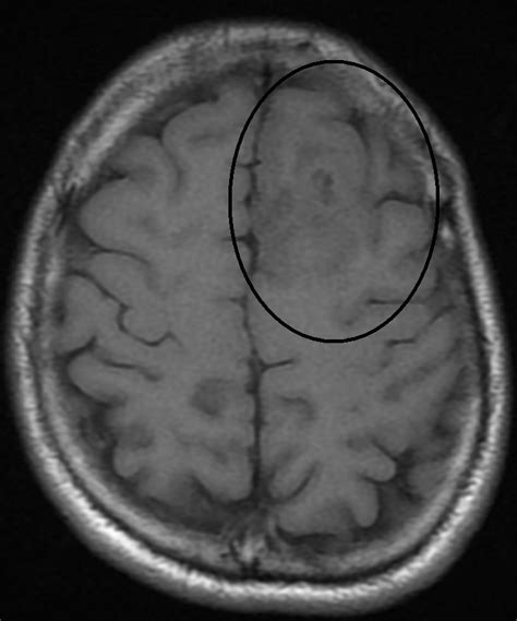 Oligodendroglioma; Oligodendroblastoma