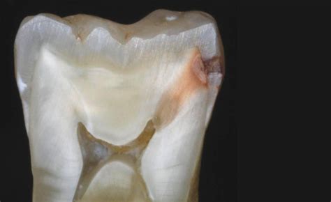 Diagnosis Dental Caries Dentine Caries