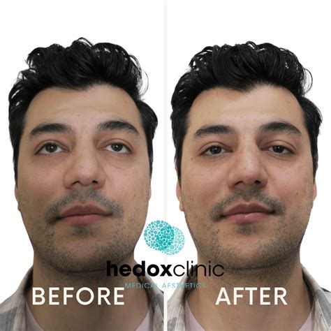 Uneven Misshapen Nose Treatment London Nasal Bridge Tip Filler Hedox Clinic