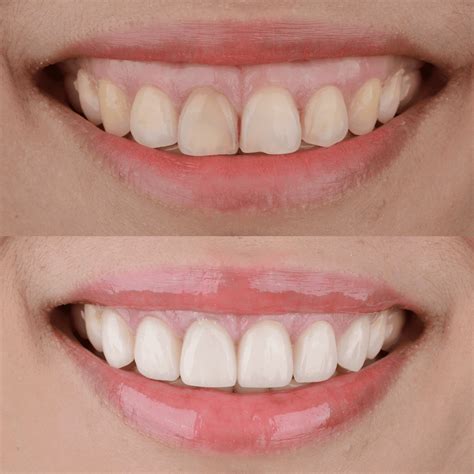 Fixing A Gummy Smile Excessive Gingival Display