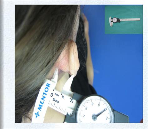 Figure 1 from Is Mastoid Pressure Dressing Necessary? | Semantic Scholar