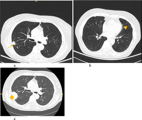 A Demonstrates A Spiculated Subpleural Nodule In The Right Upper Lobe Download Scientific