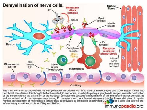 Guillain barré syndrome