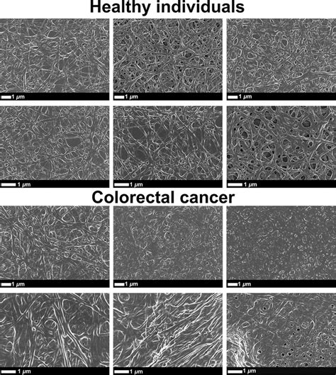 Representative Scanning Electron Micrographs Of Fibrin Clots From Download Scientific Diagram