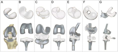 An Overview Of Revision Knee Prostheses On The Market Illustrating