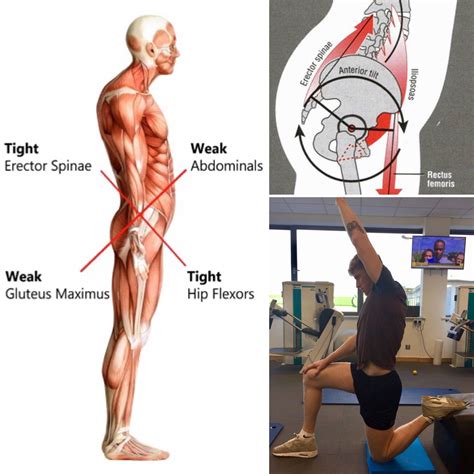 Fix Anterior Pelvic Tilt In Minutes Per Day With This Corrective