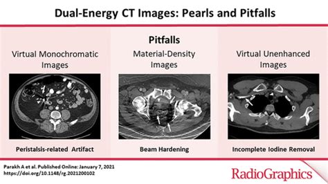 Dual Energy Ct Images Pearls And Pitfalls Radiographics