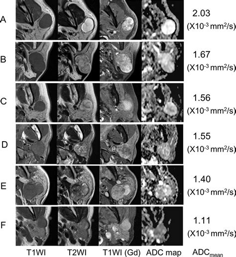 MRI Of Representative Cases With Pleomorphic Adenoma Tumors On The