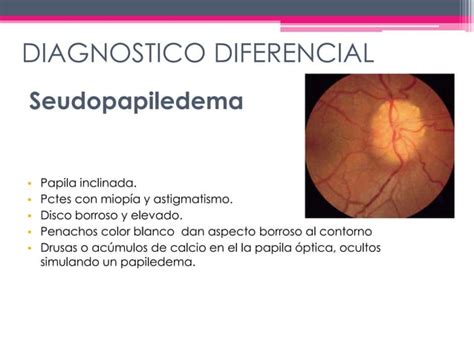 Edema De Papila PPT