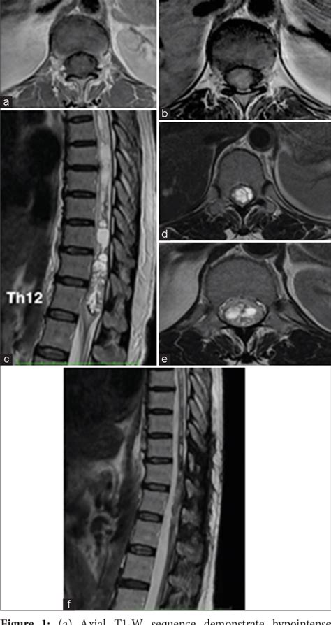 Figure 1 From Intramedullary Clear Cell Ependymoma Of The Lower