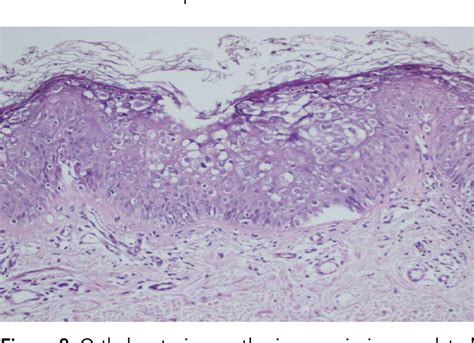 Figure 1 From A Case Of Epidermodysplasia Verruciformis Treated With