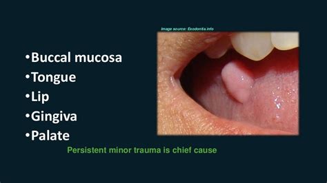 Oral Fibro Epithelial Polyp