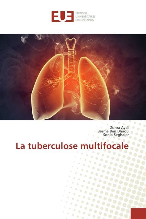 La Tuberculose Multifocale 978 620 2 26185 2 9786202261852 6202261854