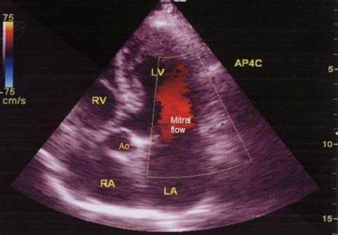 Apical Five Chamber View In Echocardiography All About Cardiovascular