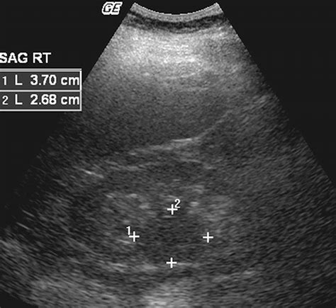 Microwave Ablation Principles And Applications Radiographics