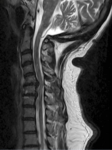 T2 Weighted Mri Showing Multilevel Cervical Disc Disease Download