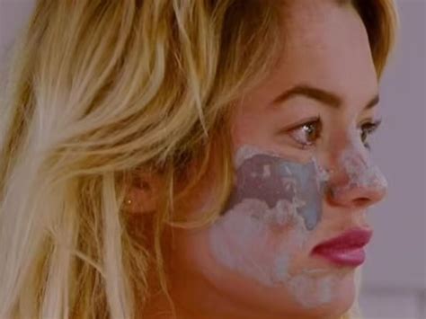 Big Brother Star Tilly Whitfeld Reveals Scarred Face After Botched Tiktok Beauty Treatment