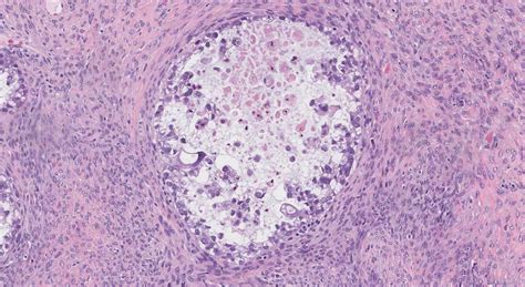 Clear Cell Carcinoma Of The Ovary Ottawa Atlas Of Pathology