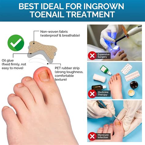 Glue Free Ingrown Toenail Corrector Patch 50 Pcs Treatment Tool For