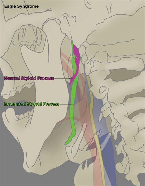 Eagle Syndrome StatPearls NCBI Bookshelf