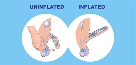 How Does A Penile Implant Work Porn Pics Sex Photos XXX Images