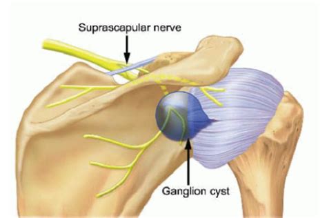 Ganglion Cyst Around Shoulder Joint Dr Rahul Bade