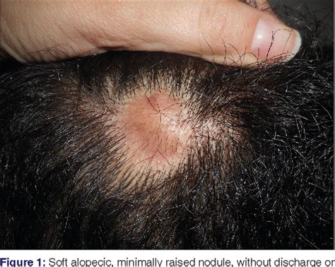 Figure 1 From Dissecting Cellulitis Of The Scalp Early Diagnosed By Color Doppler Ultrasound