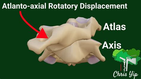 Cock Robin Deformity In Atlanto Axial Rotatory Displacement Aard